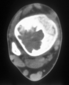 Radiographic image of cyst. 