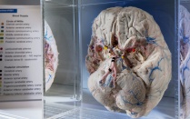 a brain on display in the Brain Museum. 