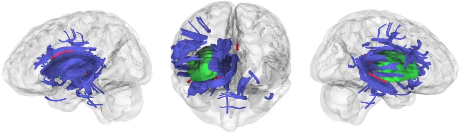 Three views of a brain scan. 