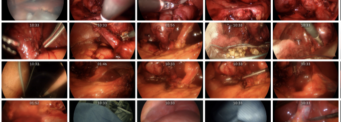 UB DARTS Laparoscopic Cholecystectomy Video Dataset. 